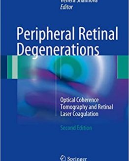 Peripheral Retinal Degenerations Optical Coherence Tomography and Retinal Laser Coagulation